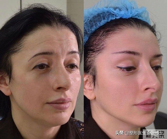 给你一份40岁后、性价比高的医美抗衰清单 图片-1