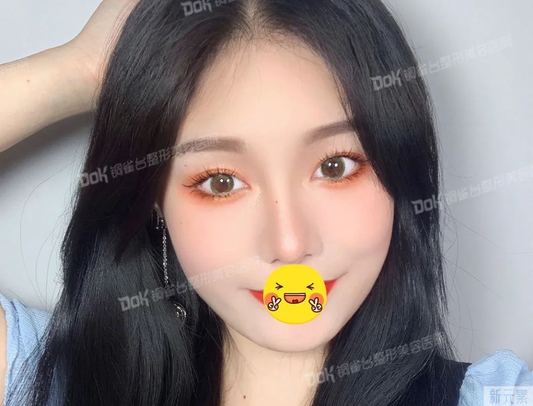 自体脂肪必看攻略 