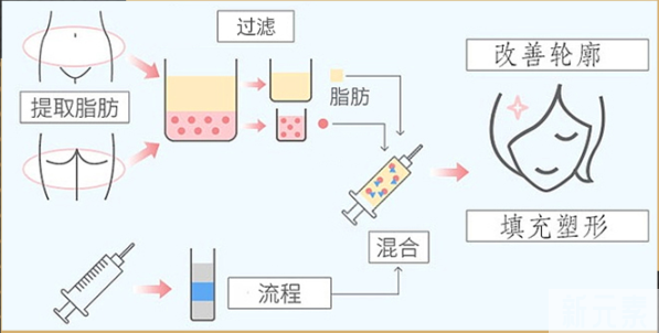 自体脂肪必看攻略 