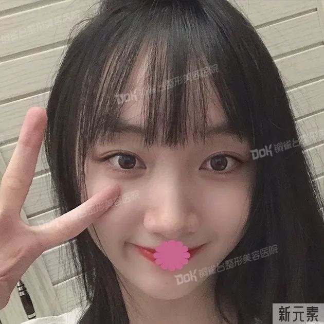 自体脂肪必看攻略 