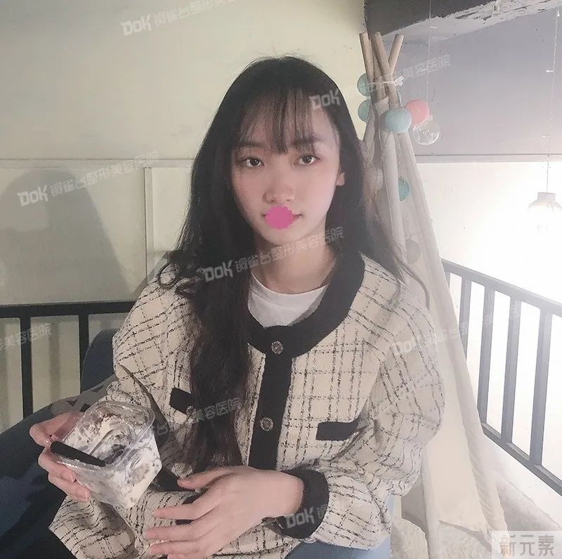 自体脂肪必看攻略 