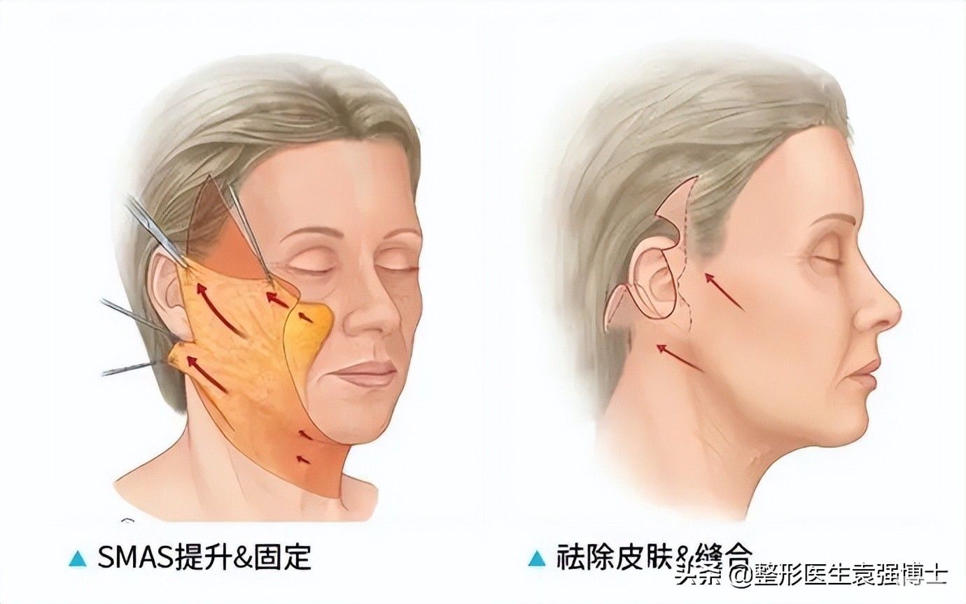 拉皮手术疼、维持时间短、上瘾、做了会更老?听医生细说真相 图片-2