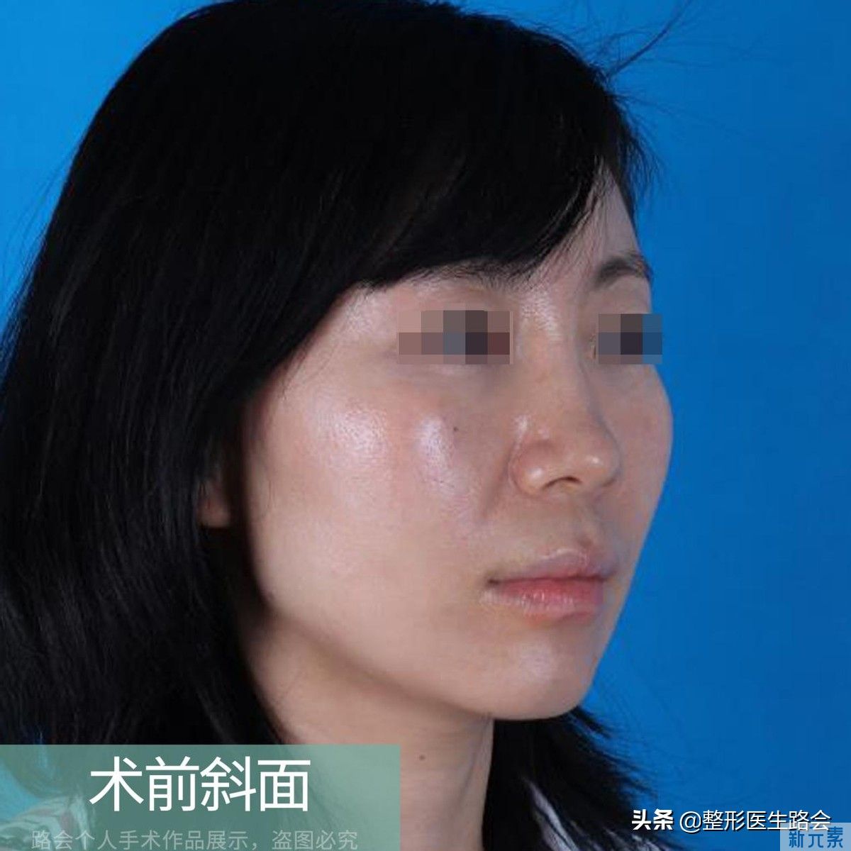 后悔?尝试过奥美定、玻尿酸隆鼻，10年后她又来了 图片-2