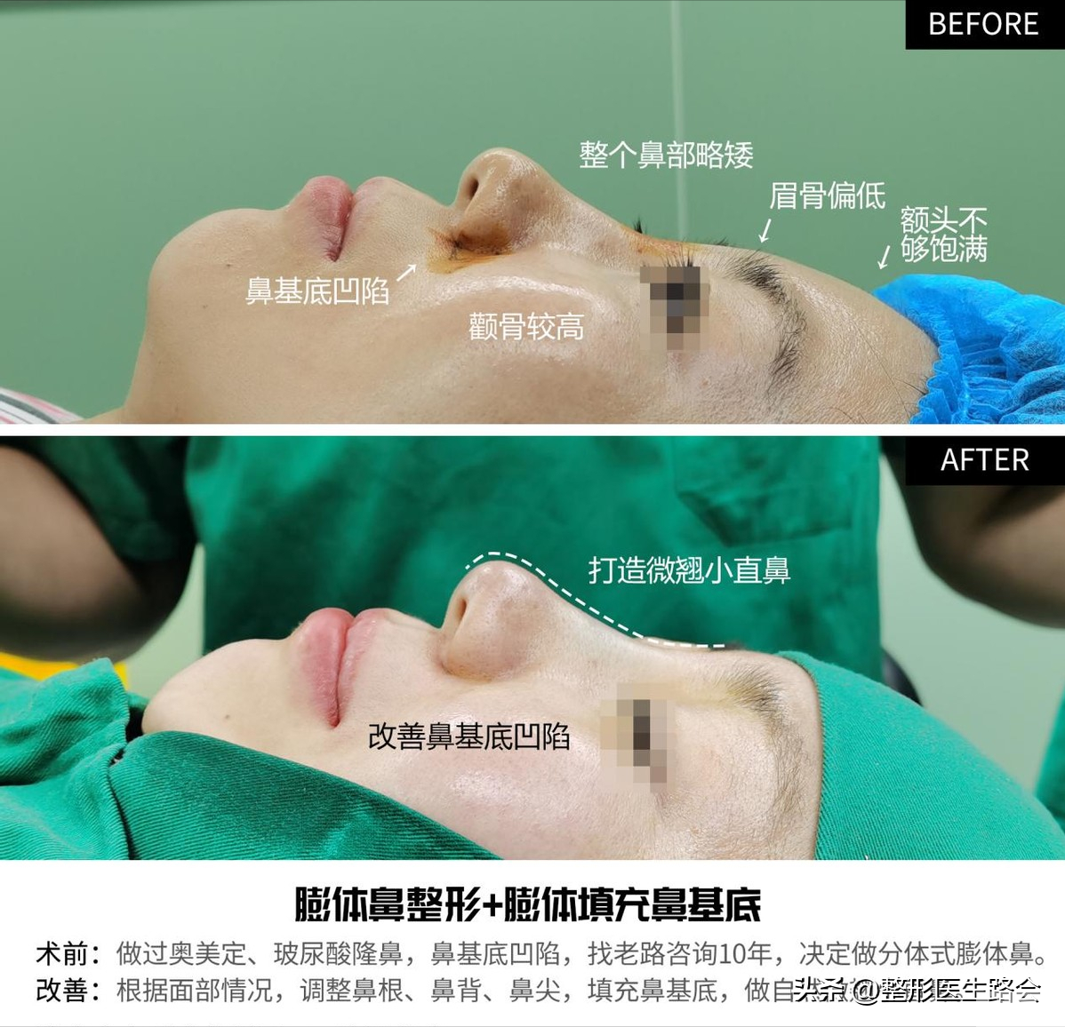 后悔?尝试过奥美定、玻尿酸隆鼻，10年后她又来了 图片-7