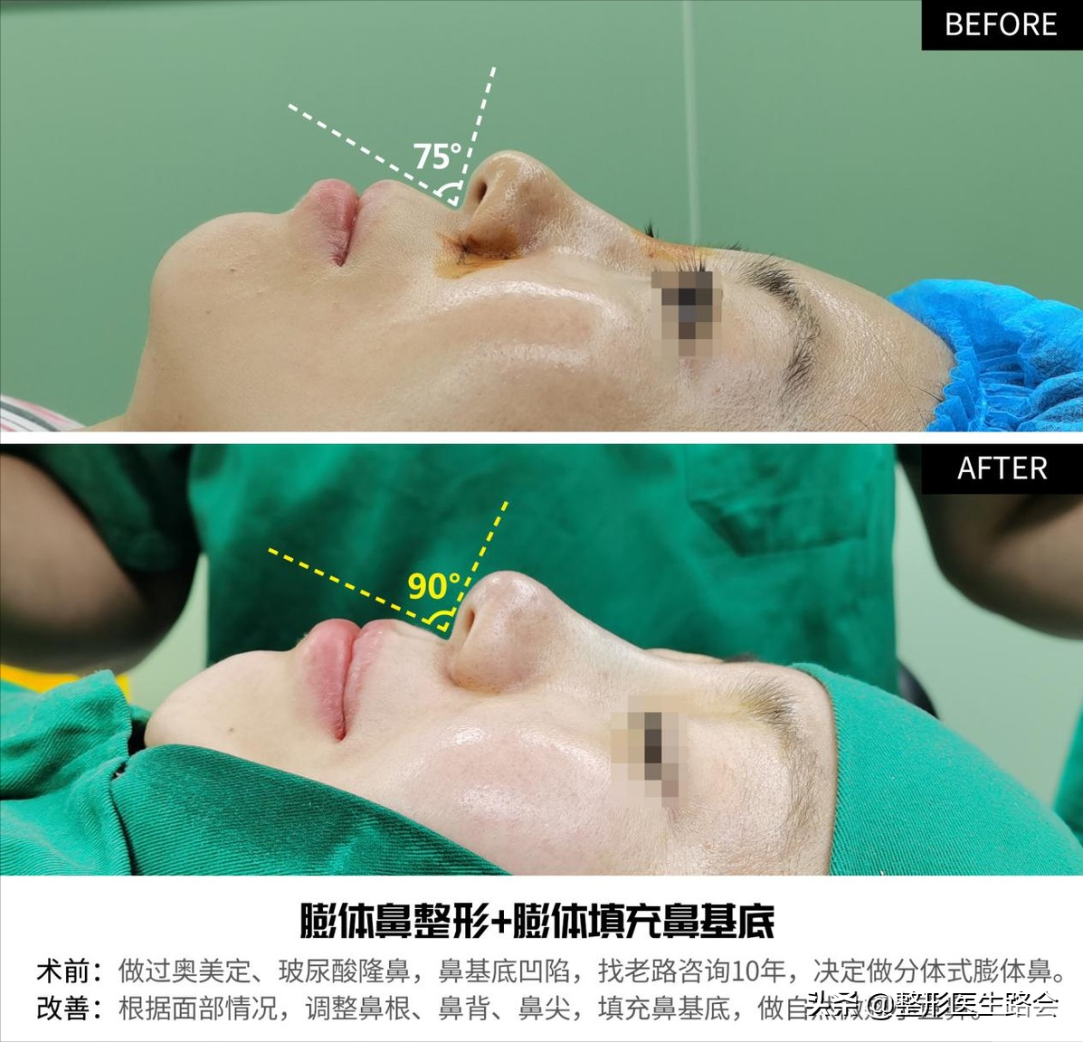 后悔?尝试过奥美定、玻尿酸隆鼻，10年后她又来了 图片-8