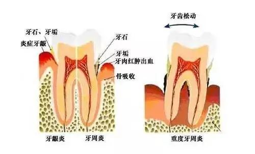 年纪大了就不能做正畸?不!年龄可不是限制 图片-5