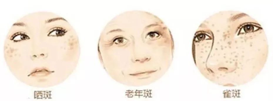 斑点顽固祛不掉?科学祛斑才是正道 图片-3