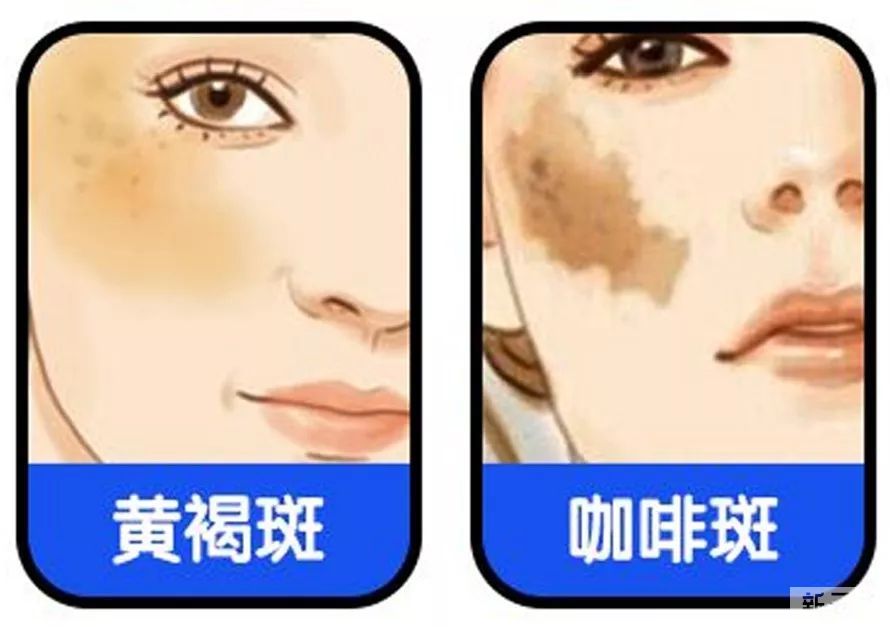 斑点顽固祛不掉?科学祛斑才是正道 图片-7