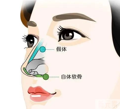 追求5分到9分的颜值飞跃，有效隆鼻很关键! 图片-5