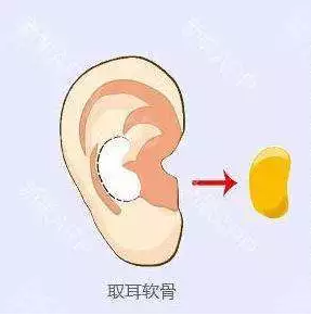 追求5分到9分的颜值飞跃，有效隆鼻很关键! 图片-6