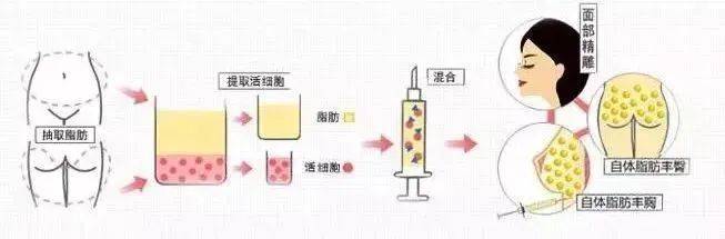 做自体脂肪填充的黄金年龄是多少? 图片-5