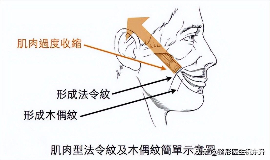 脸上有了法令纹?消除真的不难，这“3个方法”实用又有效 图片-1