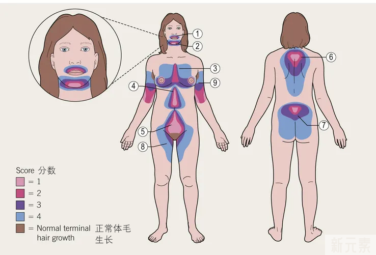 女生的体毛变粗变密不是刮出来的?而是因为这个...... 图片-3