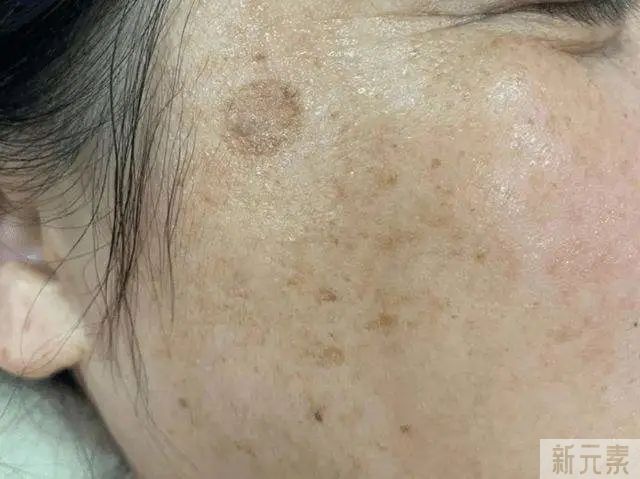 科普 ▏万“斑”无奈，你知道自己长的什么斑吗? 图片-4