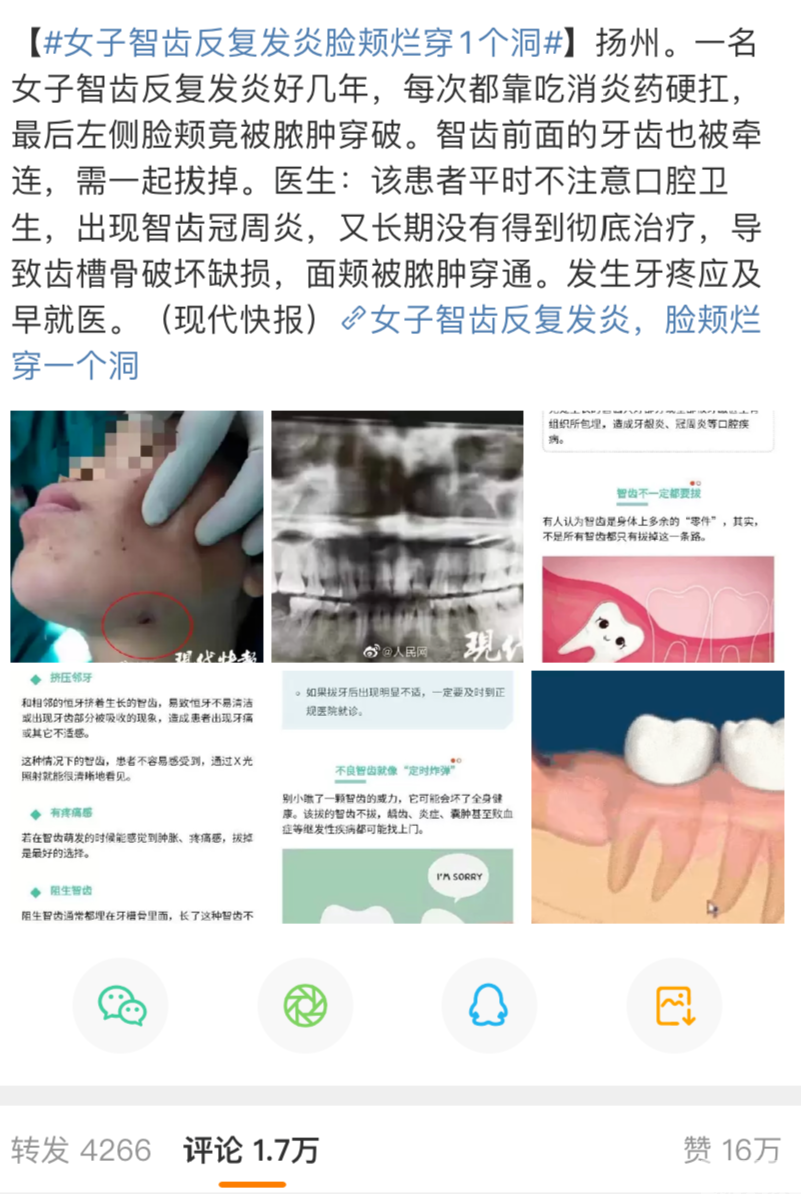 智齿不痛拔不拔?医生:这些被点名的智齿都要拔! 图片-3