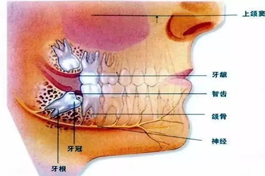 智齿不痛拔不拔?医生:这些被点名的智齿都要拔! 图片-8