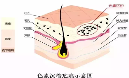 ​酱油真的会让疤痕颜色变深?色素疤怎么预防?详细解答来了! 图片-9