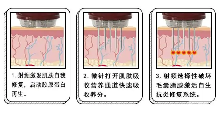 毛孔粗大/暗沉出油/痘痘、痘印的“救星”—黄金微针来咯!现在买超划算! 图片-9