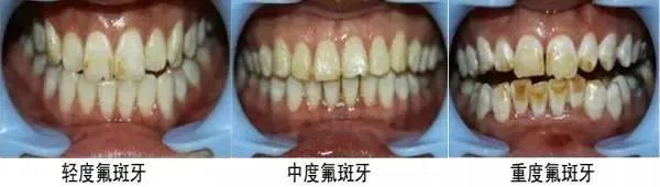 漱口水9.9、洁牙68元、牙美白3次888元秒!限时抢! 图片-7