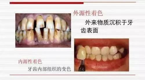 漱口水9.9、洁牙68元、牙美白3次888元秒!限时抢! 图片-6