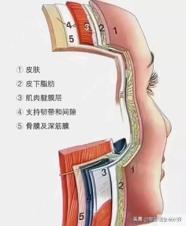 比大拉皮创伤小，比小拉皮效果好，面部五层提升手术全过程曝光 图片-1