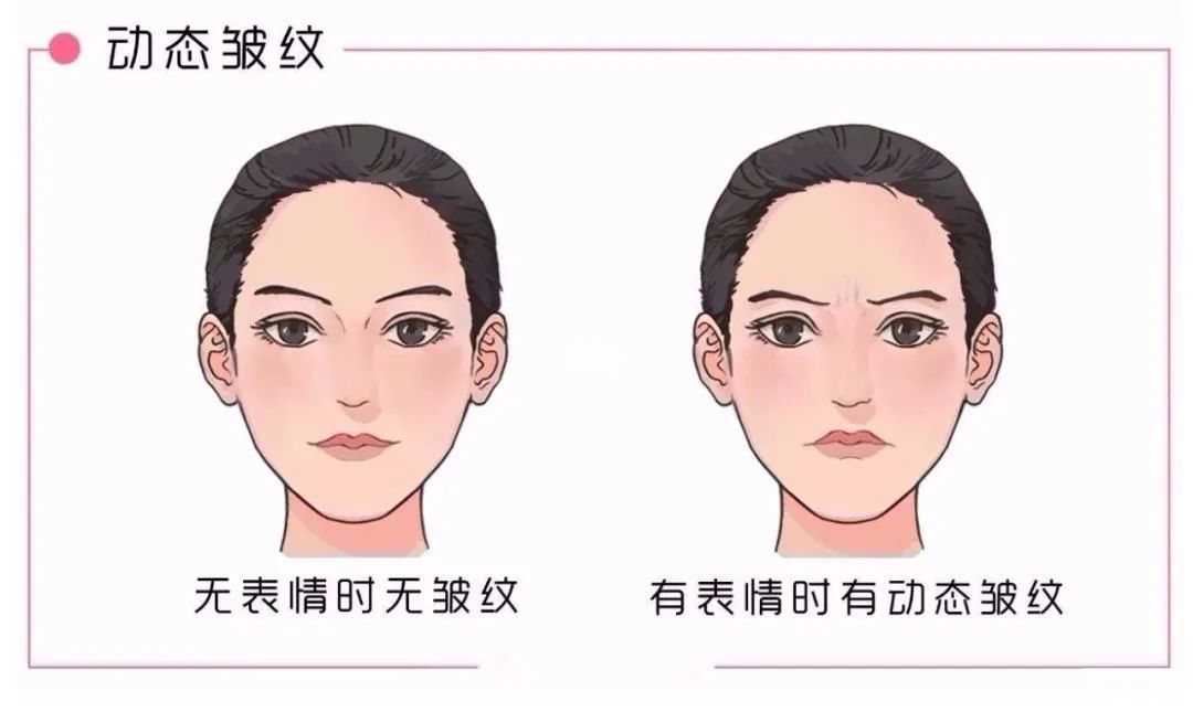 不同皱纹类型，如何选医美项目? 图片-2