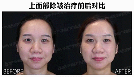 不同皱纹类型，如何选医美项目? 图片-3