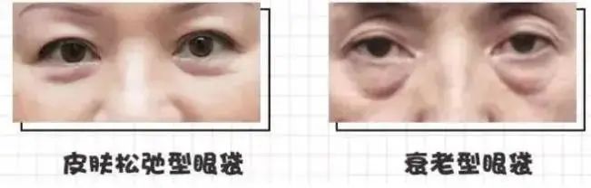 原来眼袋也有好几种，你还不清楚自己属于哪种类型? 图片-9