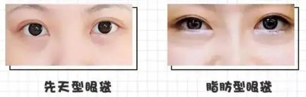 原来眼袋也有好几种，你还不清楚自己属于哪种类型? 图片-8