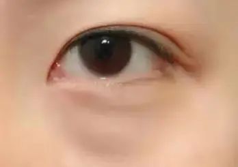 原来眼袋也有好几种，你还不清楚自己属于哪种类型? 图片-6