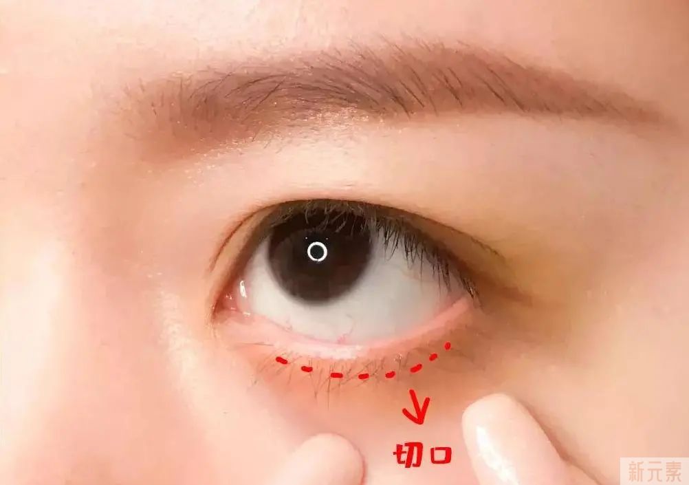 原来眼袋也有好几种，你还不清楚自己属于哪种类型? 图片-11