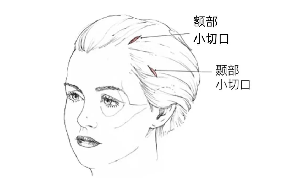 效果维持5-8年!这个立竿见影的抗衰手术，胜在哪里? 图片-8