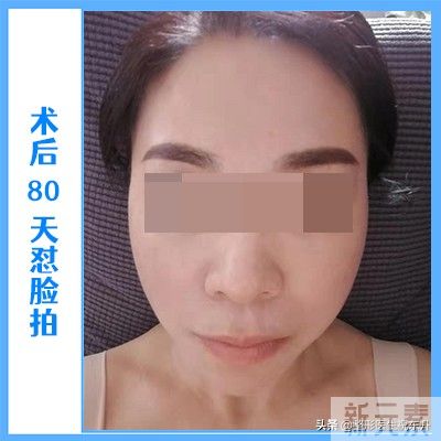 51岁大姐拉皮真实经历，术后4个月，这几张实拍图美到老公认不出! 图片-6