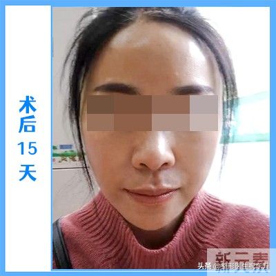 51岁大姐拉皮真实经历，术后4个月，这几张实拍图美到老公认不出! 图片-4