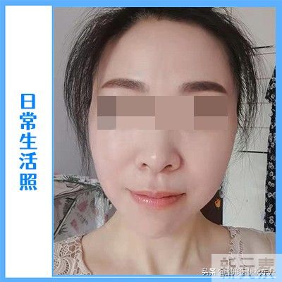 51岁大姐拉皮真实经历，术后4个月，这几张实拍图美到老公认不出! 图片-8