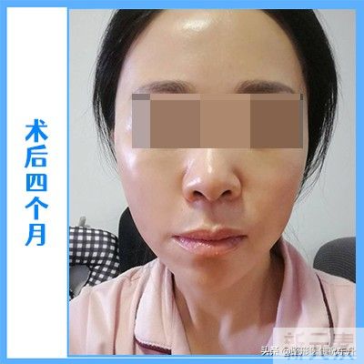 51岁大姐拉皮真实经历，术后4个月，这几张实拍图美到老公认不出! 图片-7