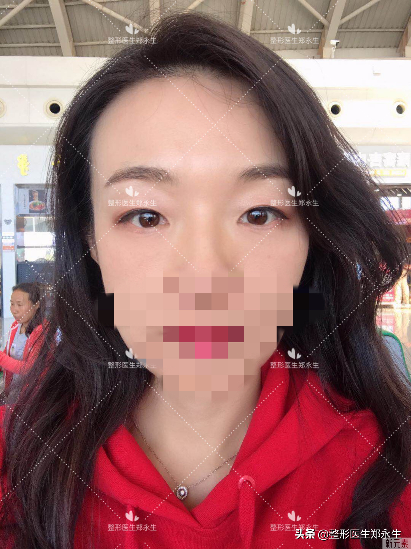 40岁做完眼袋大变样，跟大家分享手术和恢复期的真实感受 图片-6