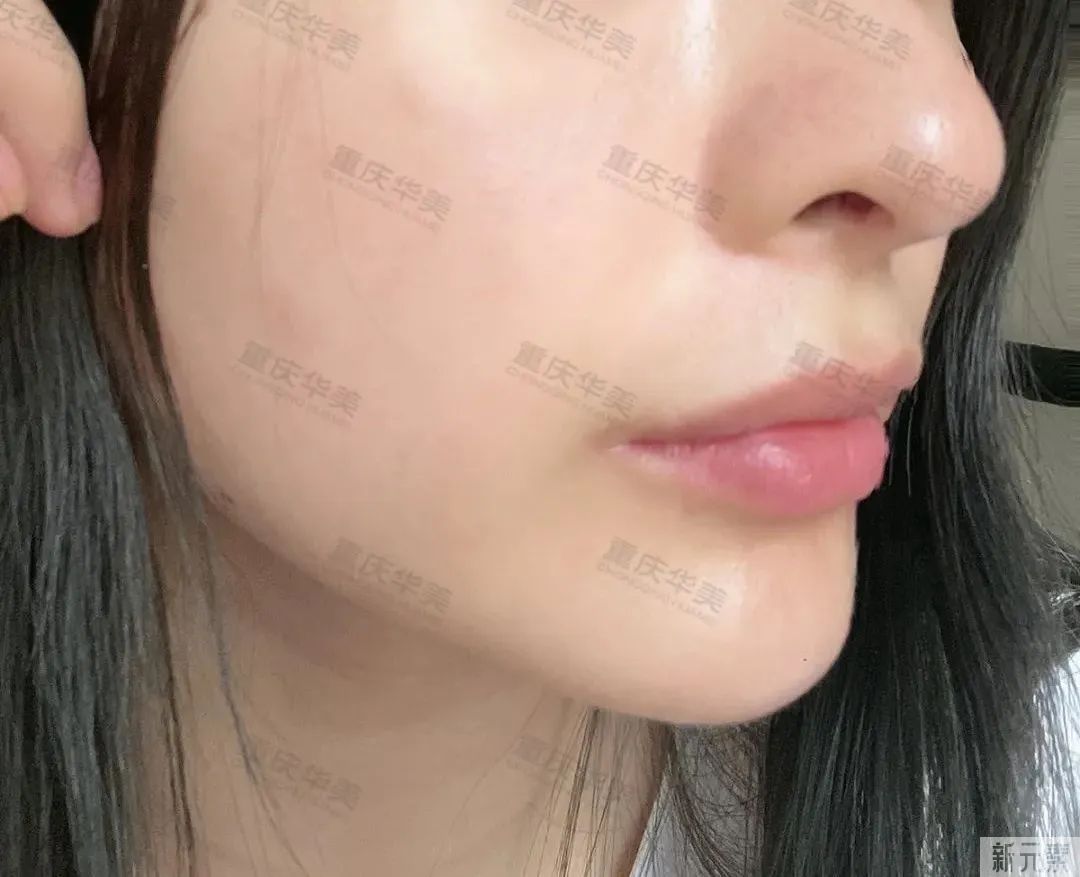 想要素颜也抗打?不如试试这款光速度达9倍的光子嫩肤 图片-2