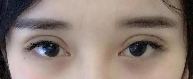 为什么有的人双眼皮看起来很假? 图片-5