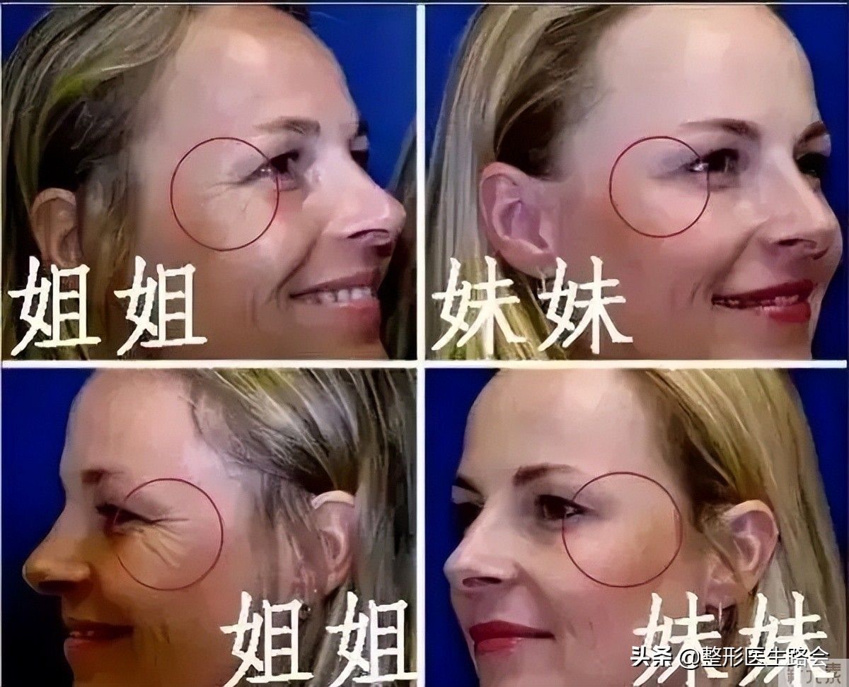 10问10答:进口与国产的肉毒素(除皱、瘦脸针)哪种更好? 图片-3
