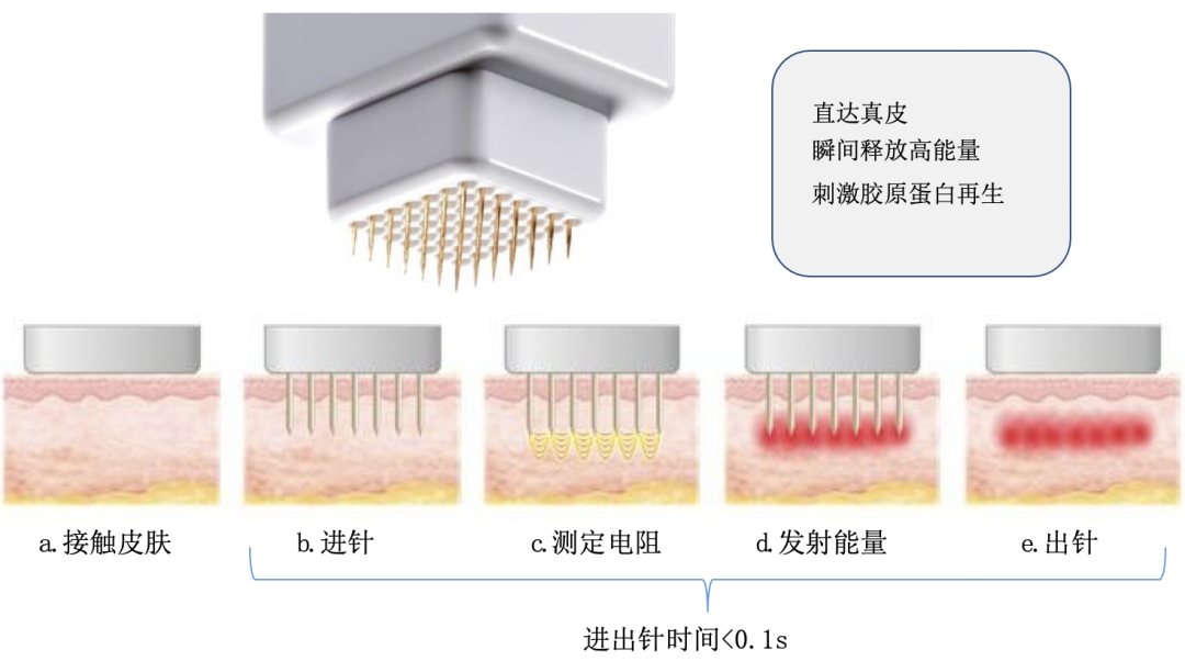 不疼且效果优异的INTRAcel 5D 黄金射频微针，到底是什么来头? 图片-5