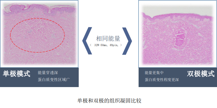 不疼且效果优异的INTRAcel 5D 黄金射频微针，到底是什么来头? 图片-12