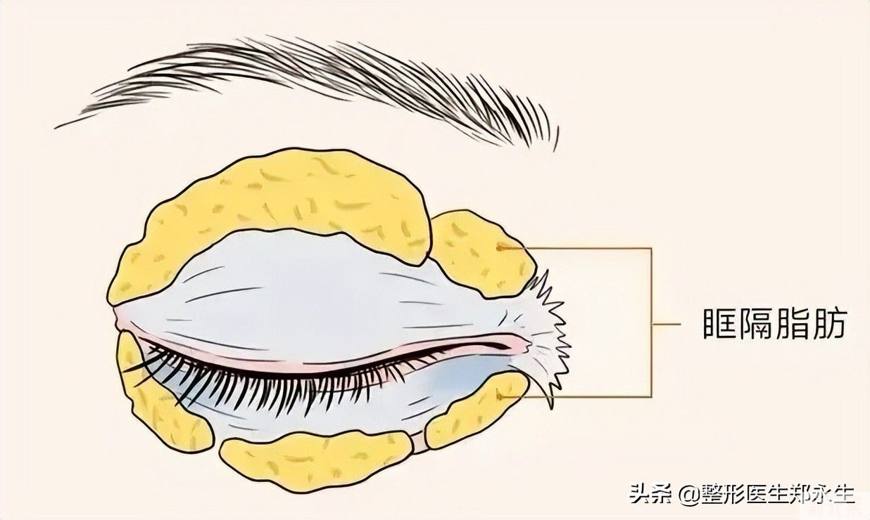 眼袋脂肪像黄金一样宝贵，去眼袋要适量，千万别把脂肪全部去掉 图片-3
