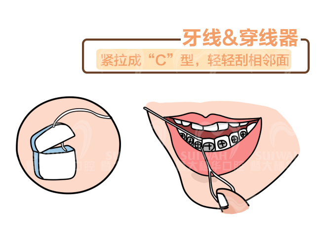 牙齿矫正期间的孩子，会更容易蛀牙吗? 图片-9