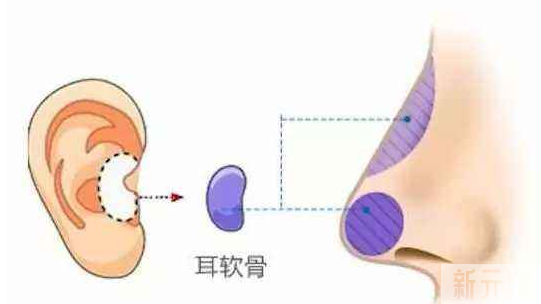 肋软骨&鼻中隔软骨&耳软骨，不同自体软骨隆鼻有什么区别?怎么选? 图片-6