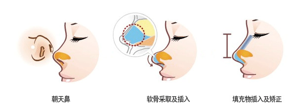 肋软骨&鼻中隔软骨&耳软骨，不同自体软骨隆鼻有什么区别?怎么选? 图片-10