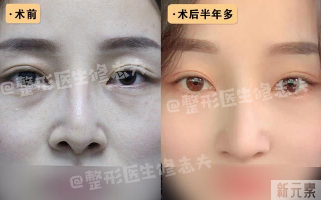 第一次做鼻综合隆鼻是什么体验? 图片-6