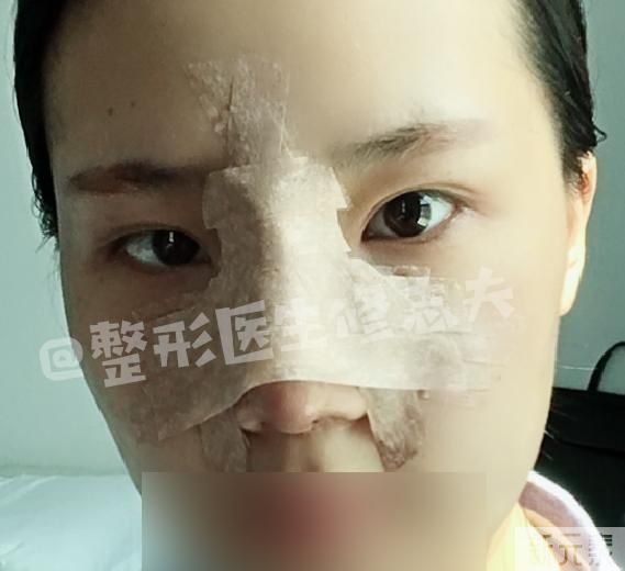 第一次做鼻综合隆鼻是什么体验? 图片-5