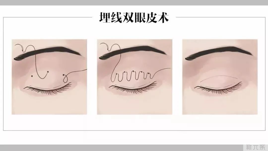 原来双眼皮手术的价格是这样算的? 图片-3