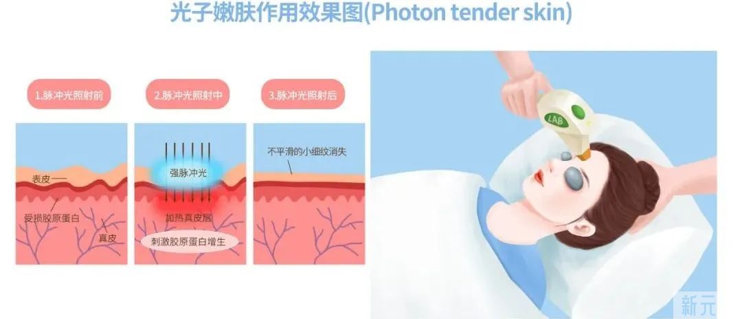 仪器太多不会选?光子嫩肤“硬货”来了! 图片-6